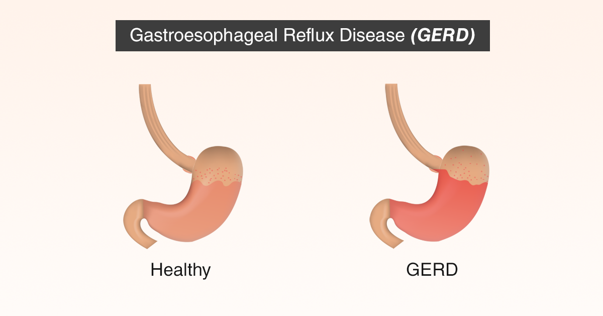 WLS and Gastroesophageal Reflux Disease (GERD) ObesityHelp