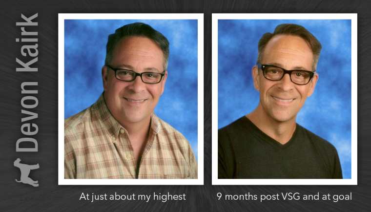 Living with the Vertical Sleeve Gastrectomy