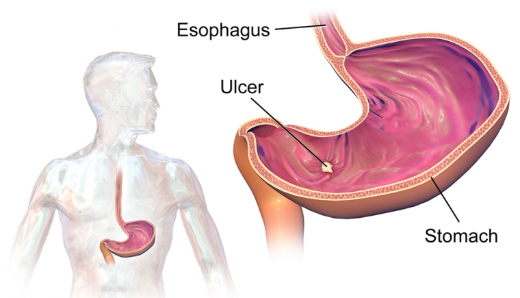 ulcers after wls