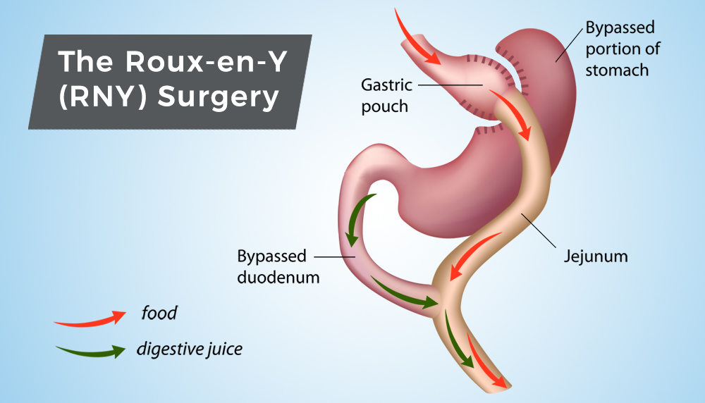 pin-on-bariatric-surgery