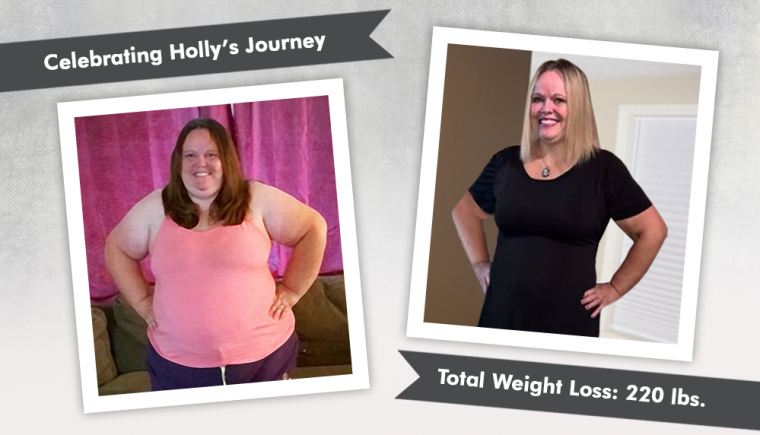 Before After Duodenal Switch DS with Holly