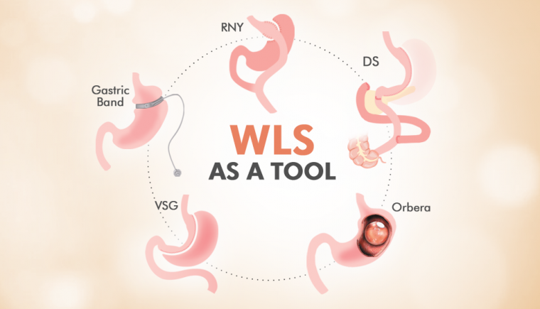 weight loss surgery is a tool